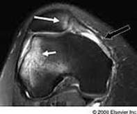 Axial MRI Patella Dislocation