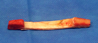 Bone Patellar Tendon Bone Graft