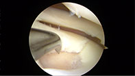 Chondral Tibial Flap Microfracture