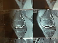 Osteochondral Defect MFC