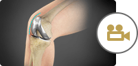Minimally Invasive Joint Replacement