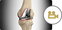 Revision Knee Replacement RKR